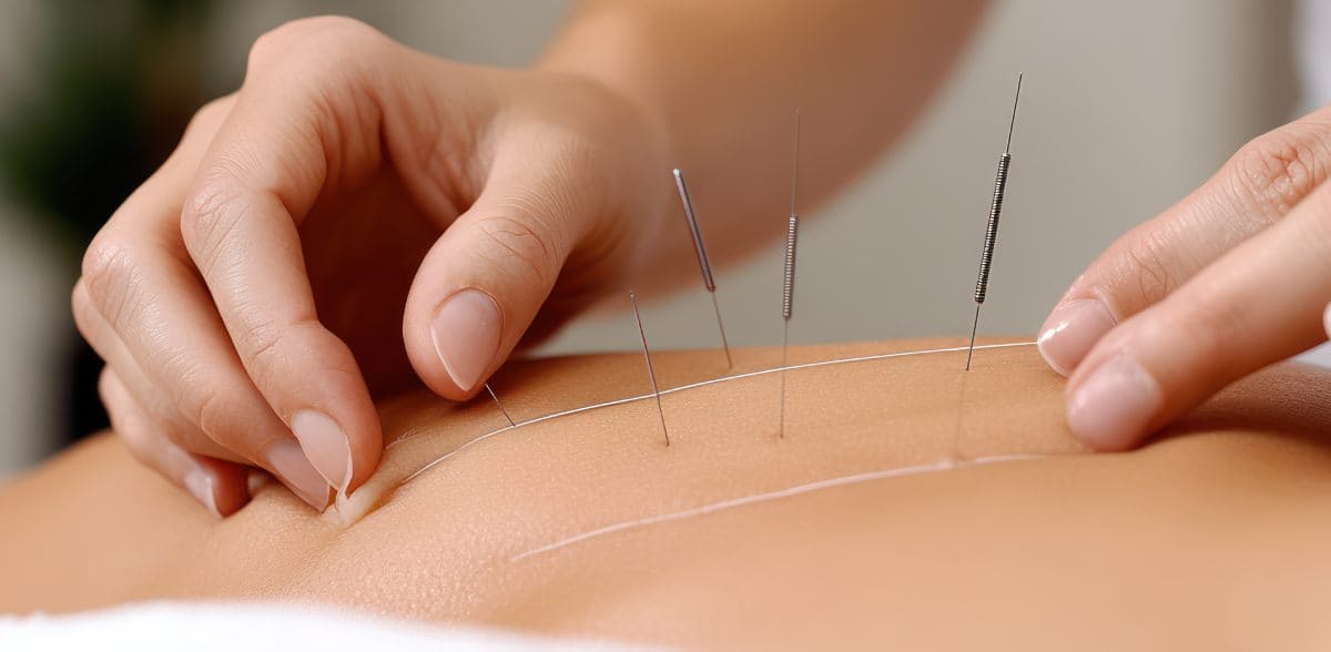 Mejor acupunturista en CDMX