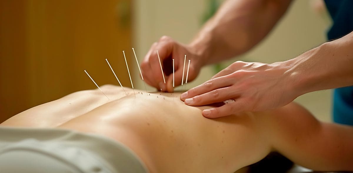 Preguntas frecuentes sobre el Tratamiento con acupuntura en CDMX
