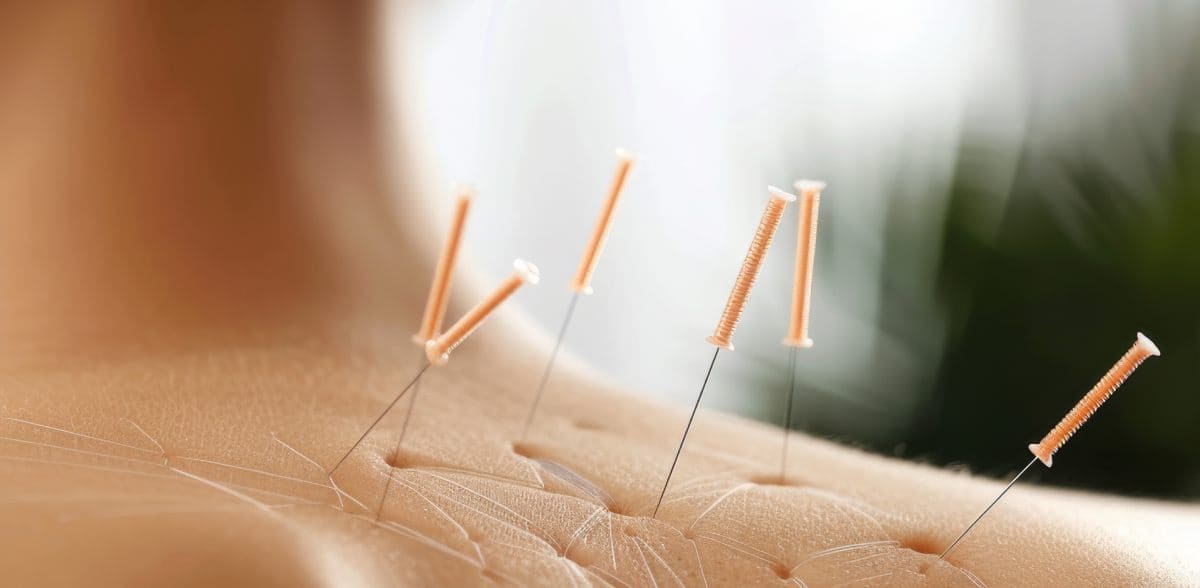 Preguntas frecuentes sobre <b>Acupunturista de calidad en CDMX</b>