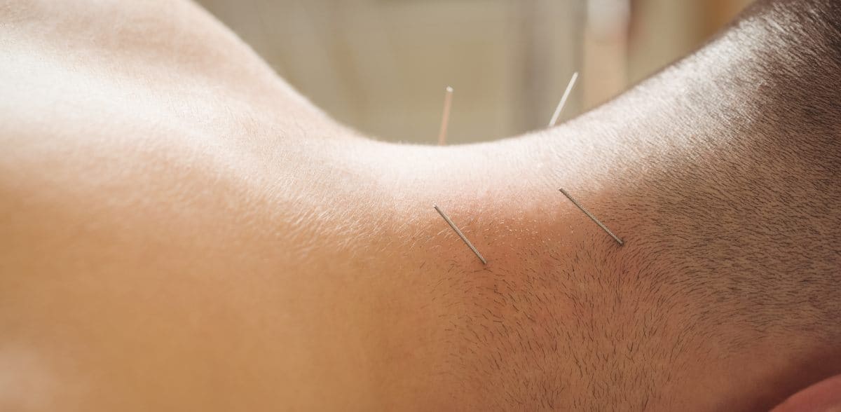 Tratamiento con acupuntura en CDMX cerca de tu ubicación