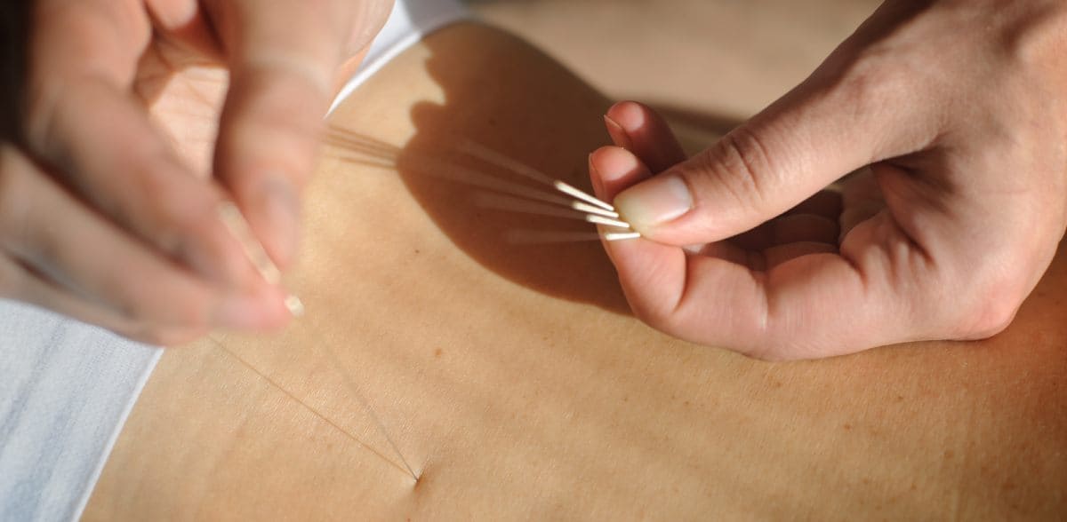 Costo de tratamiento integral con Acupuntura cerca de mi ubicación en CDMX