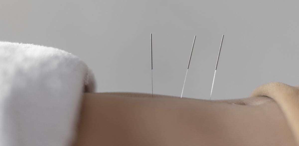 Preguntas frecuentes sobre mejor acupuntura en CDMX