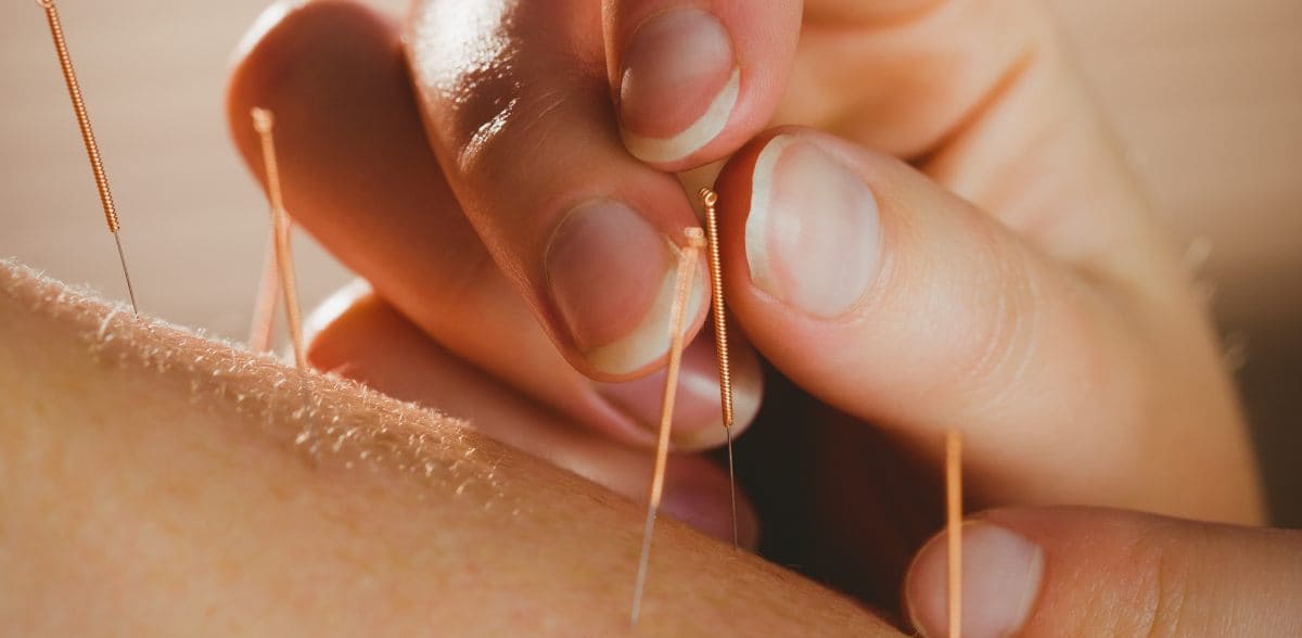 Cita con acupunturista en CDMX